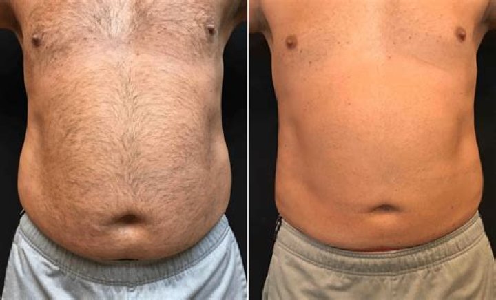 Are beer bellies permanent?