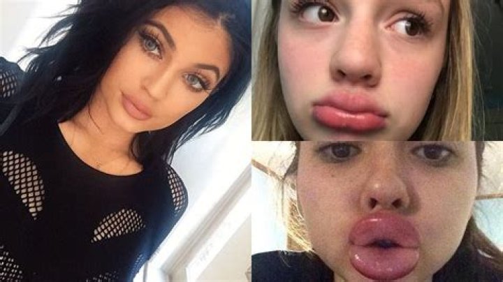 Are lip plumper bad for you?
