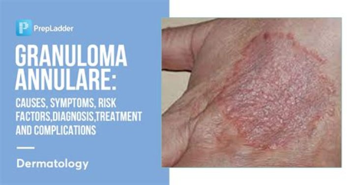 Can granuloma annulare be caused by stress?