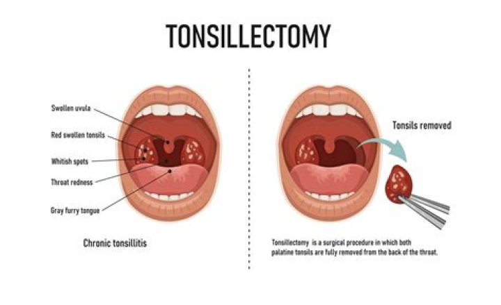 Can I drink iced coffee after tonsillectomy?