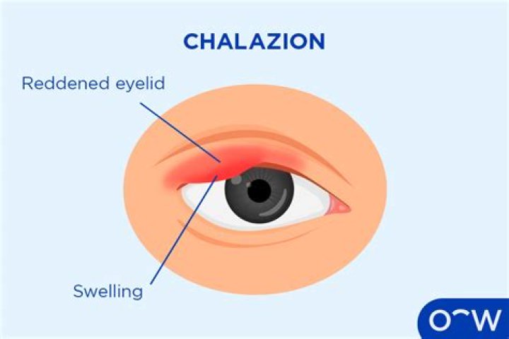 Can I pop my chalazion with a needle?