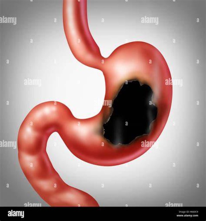 Can Takis burn a hole in your stomach?