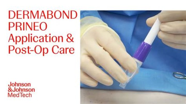 Can you peel off dermabond?