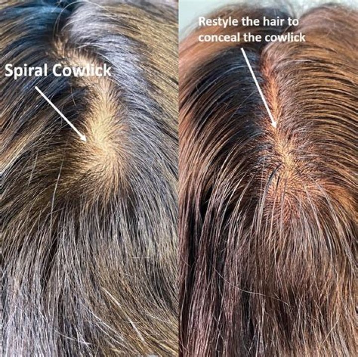 Can you permanently fix a cowlick?