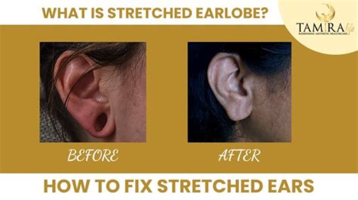 Do stretched ears ever stop smelling?