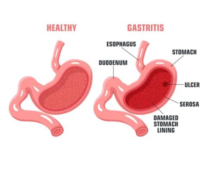 Do Takis damage stomach lining?