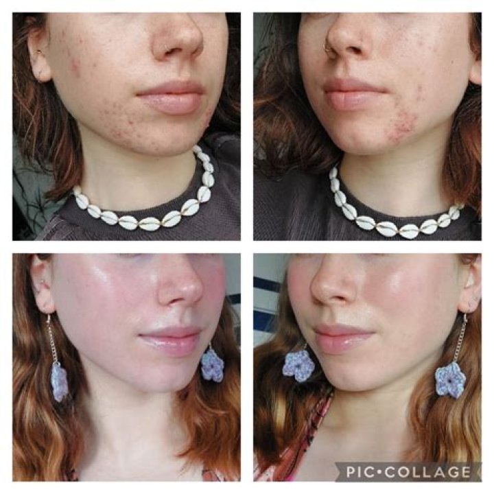 Does chlorella make acne worse?