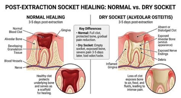 Does Gelfoam prevent dry socket?