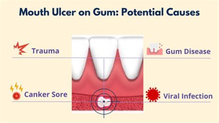 Does gum kick you out of ketosis?