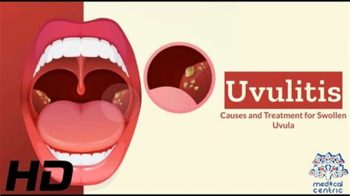 Does having your uvula removed change your voice?