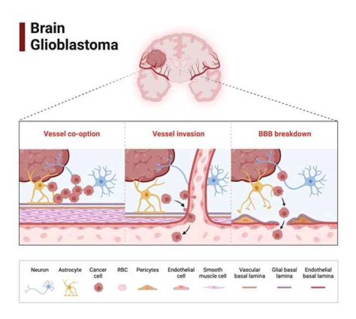Has anyone ever survived a glioblastoma?