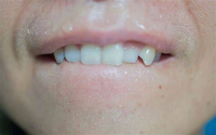 How can I make my teeth less pointy?