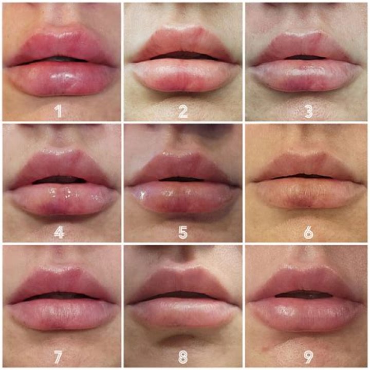How do you bring down a swollen lip?