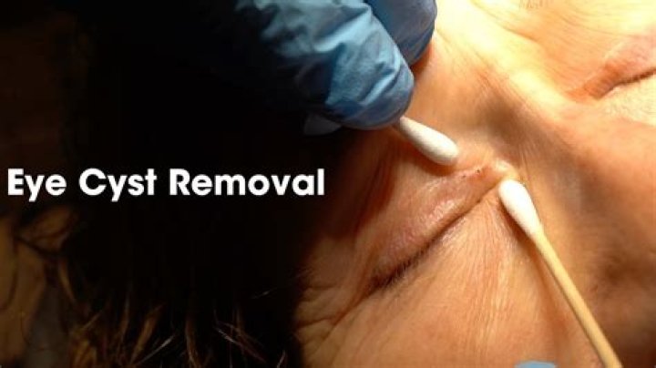 How do you get rid of a cyst on your eye fast?