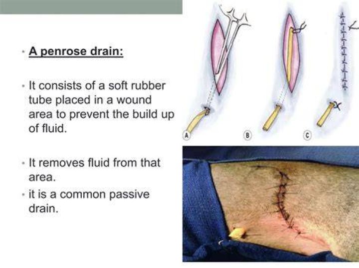 How long can a Penrose drain stay in?