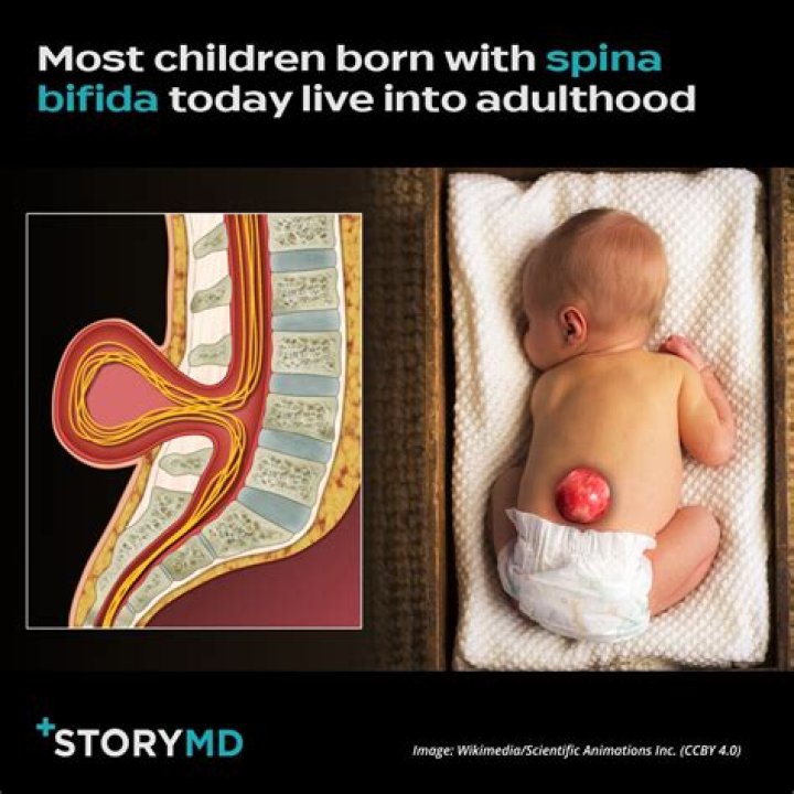 How long can a person live with spina bifida?