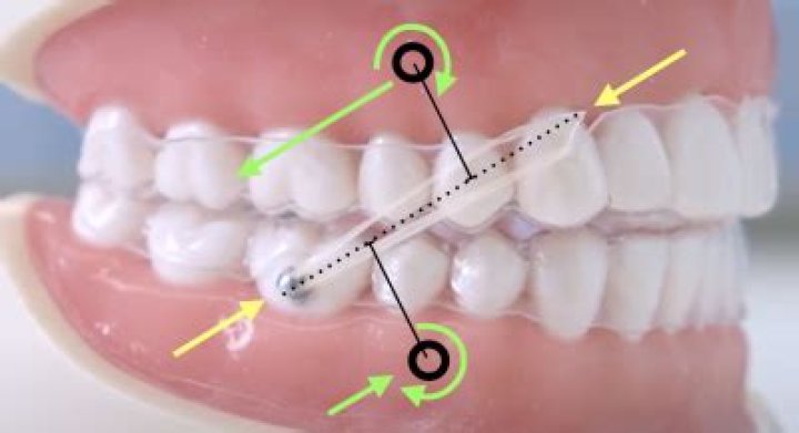 How long does it take for elastics to move your jaw?