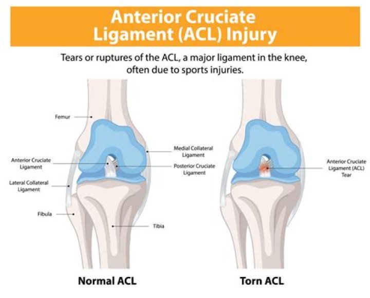 How long does it take to recover from an avulsion fracture?