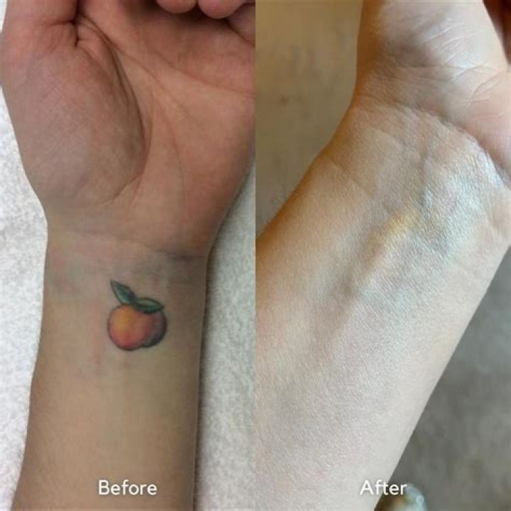 How long does it take to remove a tattoo with lemon juice?