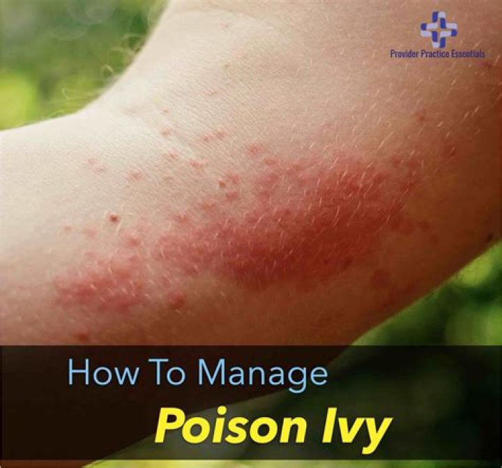 How long does poison ivy last?