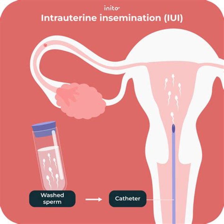 How many vials of sperm do you need for IUI?