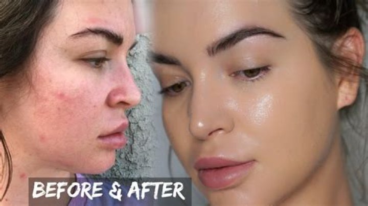 Is Foreo Luna better than Clarisonic?