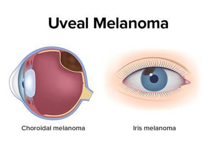 Is Ocular Melanoma curable?
