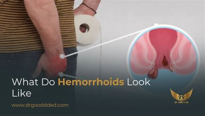 Is Proctosol good for hemorrhoids?