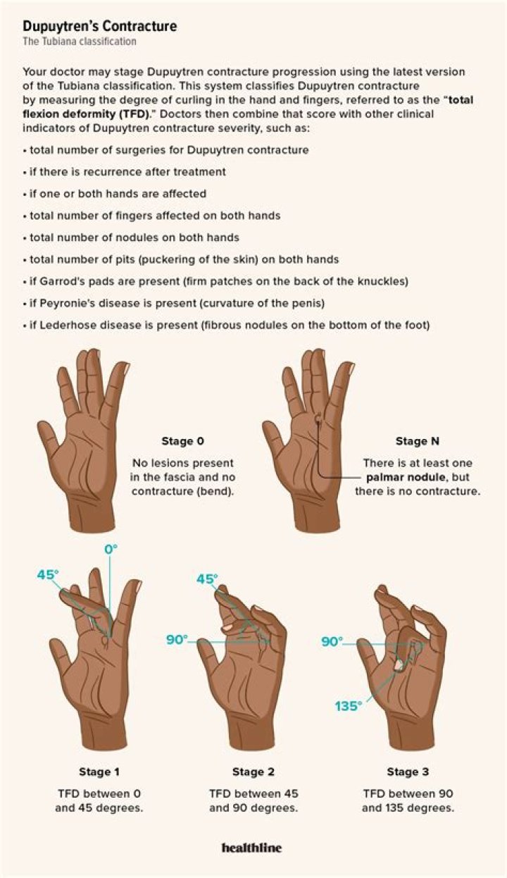 What aggravates Dupuytren's contracture? Archives | PopularAsk.net