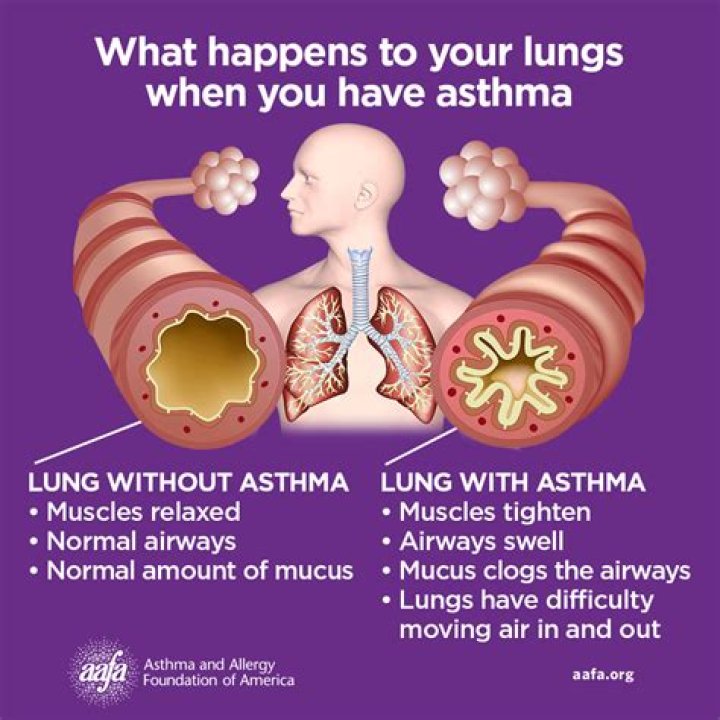 What are the classic signs of asthma exacerbation?