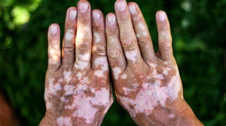 What causes discoloration in your hands?