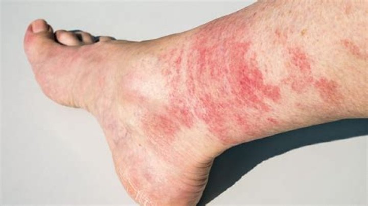 What causes redness on lower legs?