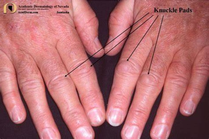 What does 4 dots on knuckles mean?