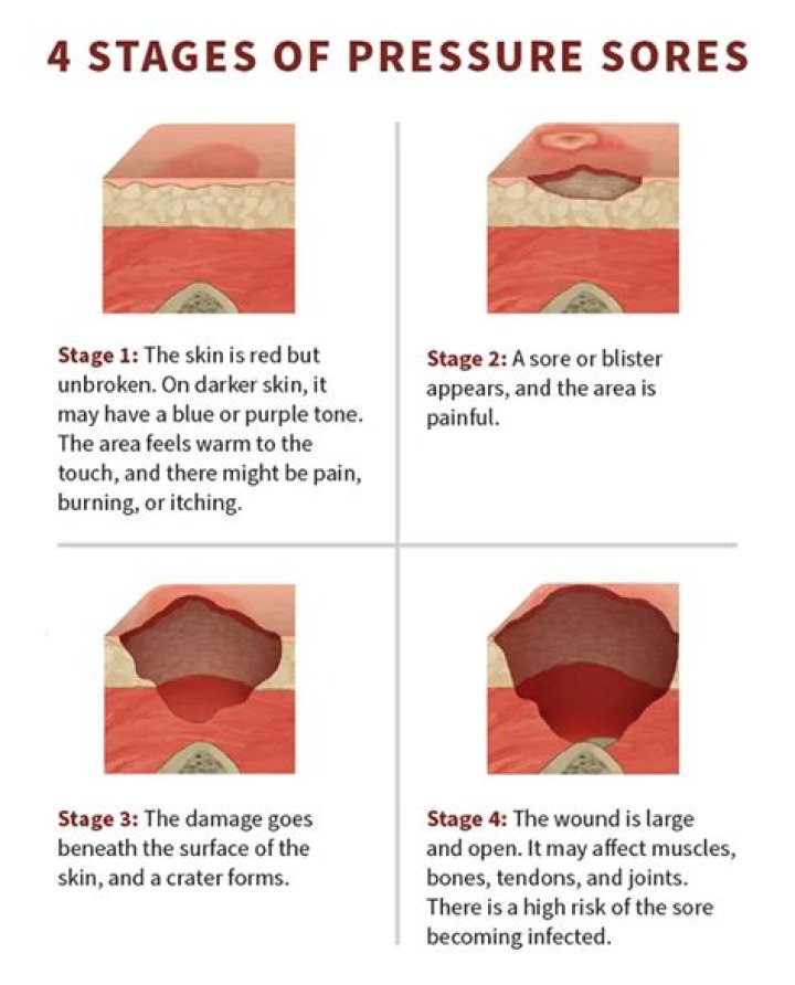 What does a Stage 4 bedsore look like?