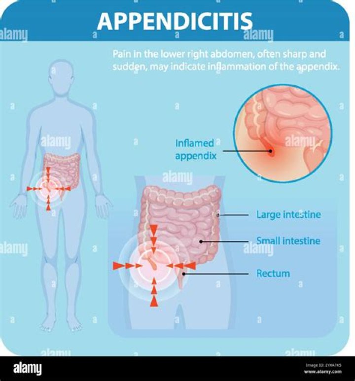 What does appendicitis feel like at the beginning?
