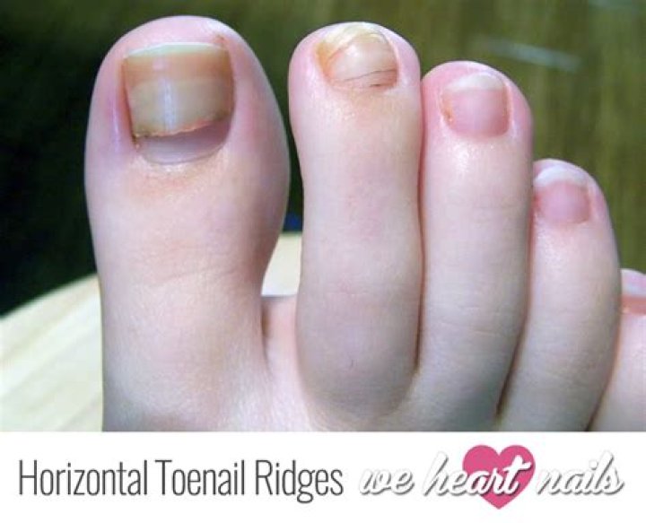 What does horizontal lines on toenails mean?