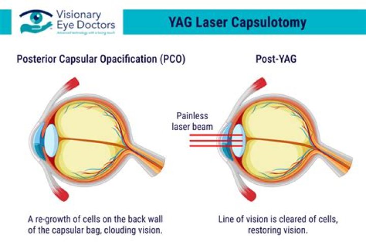 What does YAG capsulotomy stand for?