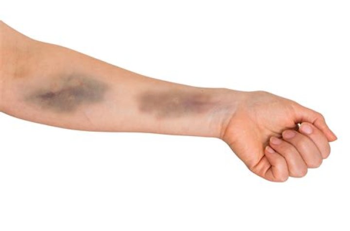 What happens if you hit a vein?