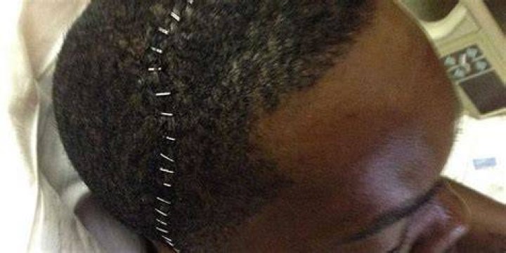 What happens if you leave staples in your head too long?