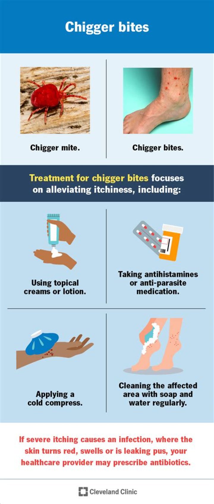 What home remedy kills chiggers?