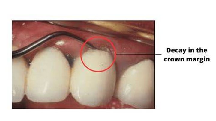 What is an open margin on a crown?