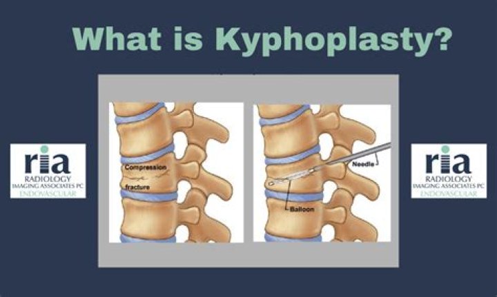 What is Kyph O?