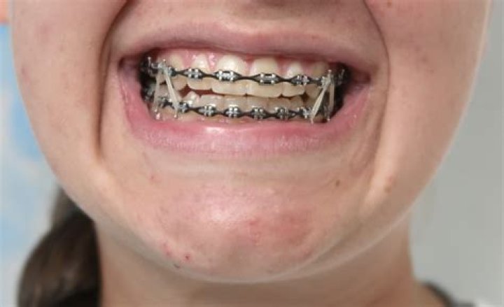 What is the final stage of braces?