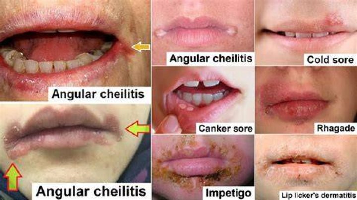 What kills angular cheilitis?