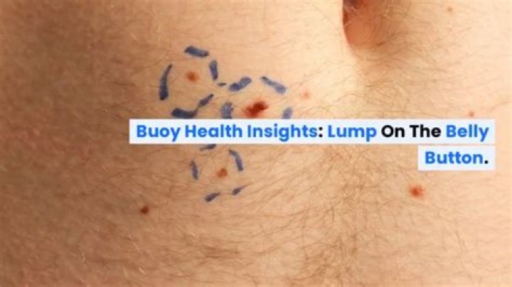 Why do I have a lump in my belly button?