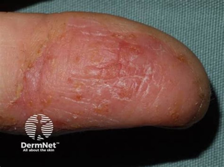 Why do I pick the skin around my fingers?