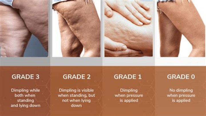 Why does my cellulite look worse on some days?