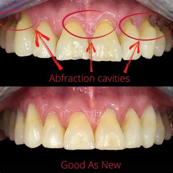 Why does the surface of my tooth feel rough?