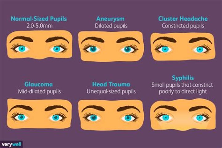 Why is my right eye bigger than my left eye?