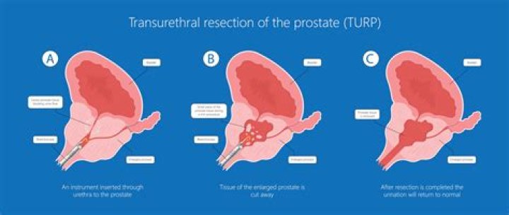 Why TURP is done?